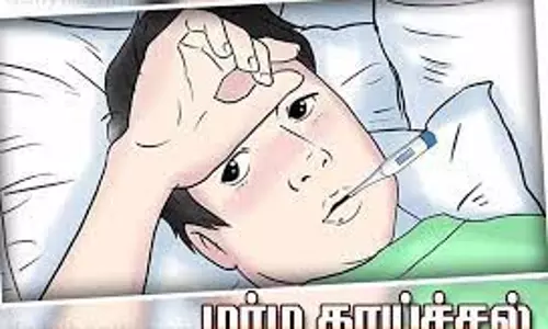 சேலம் மாவட்டத்தில் வேகமாக பரவும் மர்ம காய்ச்சல்