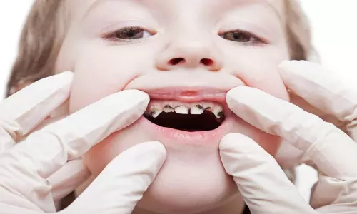 குழந்தைகளுக்கு பல் சிதைவு ஏற்பட இவை தான் காரணம்...