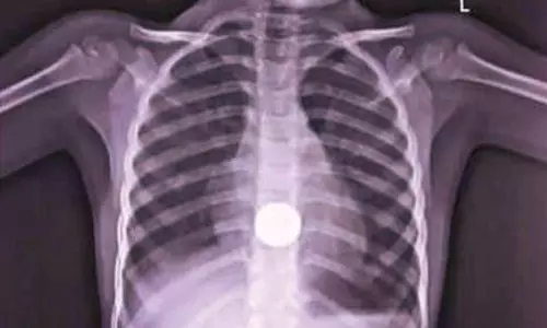 குழந்தையின் உணவுக்குழாயில் சிக்கிய 5 ரூபாய் நாணயம் அகற்றம்