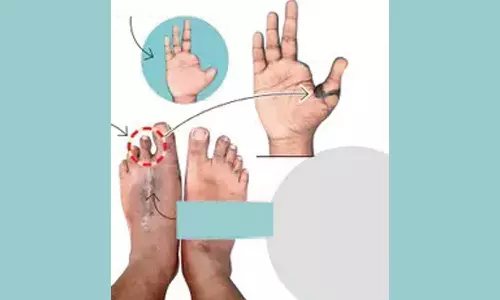 கைவிரல் துண்டான வாலிபருக்கு கால் விரல் பொருத்தப்பட்டது- தனியார் ஆஸ்பத்திரியில் 8 மணிநேரம் நடந்த ஆபரேசன்