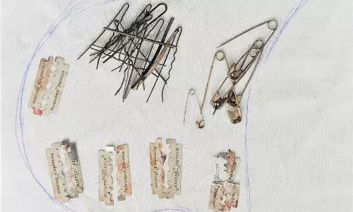 மனநலம் பாதித்த இளைஞர் வயிற்றில் இருந்து ஹேர்பின், பிளேடு, ஊக்குகள், எண்டோஸ்கோபி கருவி மூலம் அகற்றம்