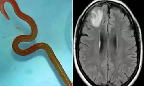 உலகிலேயே அரிய நிகழ்வு: மனித மூளையில் உயிருள்ள புழு- ஆஸ்திரேலிய மருத்துவர்கள் அகற்றினர்