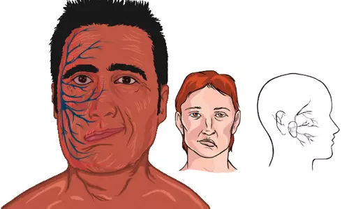 முக வாதத்தை குணமாக்கும் பயிற்சிகள்