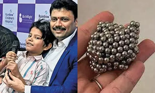 சிறுவனின் வயிற்றில் 50 காந்த உருண்டைகள்- அறுவை சிகிச்சை செய்து அகற்றம்