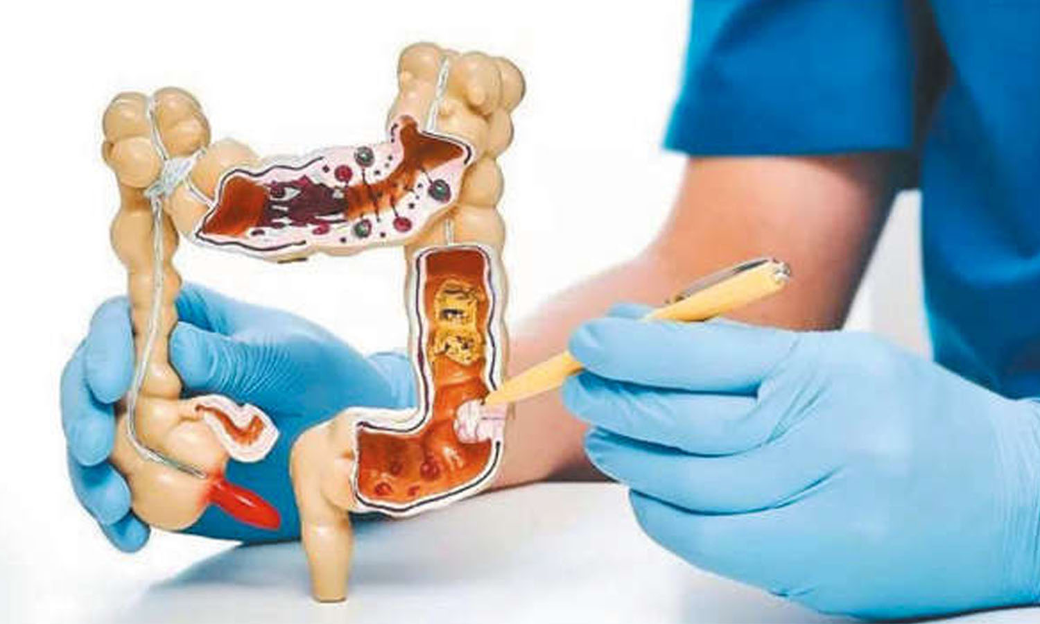 உலக அளவில் பெருங்குடல் புற்றுநோயால் உயிரிழப்பவர்களின் விகிதம் அதிகரிப்பு