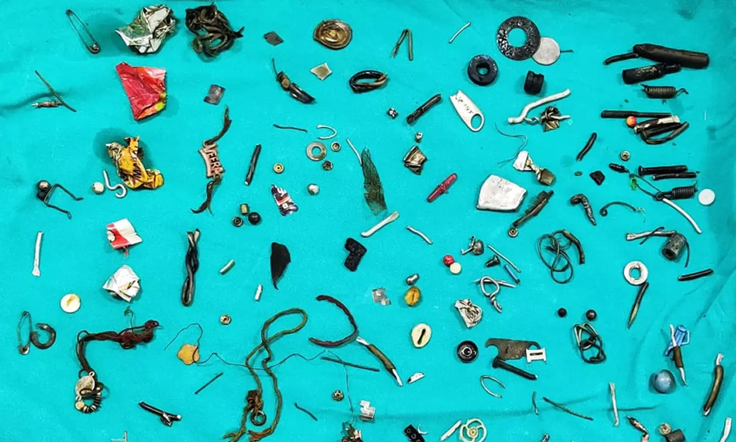 வயிறா இல்லை வேர்ஹவுஸா?; நோயாளி வயிற்றில் உலோகங்கள்: அதிர்ந்த மருத்துவர்கள் வயிறா இல்லை வேர்ஹவுஸா?; நோயாளி வயிற்றில் உலோகங்கள்: அதிர்ந்த மருத்துவர்கள்