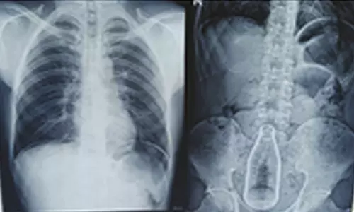 மாற்றுத்திறனாளி வயிற்றில் இருந்த குளிர்பான பாட்டில்: டாக்டர்கள் அறுவை சிகிச்சை மூலம் அகற்றினர்