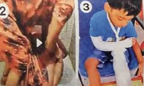 கள்ளக்காதலுக்கு இடையூறு: சிறுவனுக்கு சூடு வைத்து கைகளை உடைத்த கொடூர தாய்