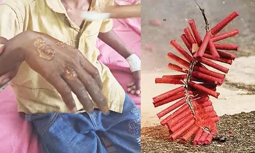 பட்டாசு வெடித்து மாணவன் காயம்