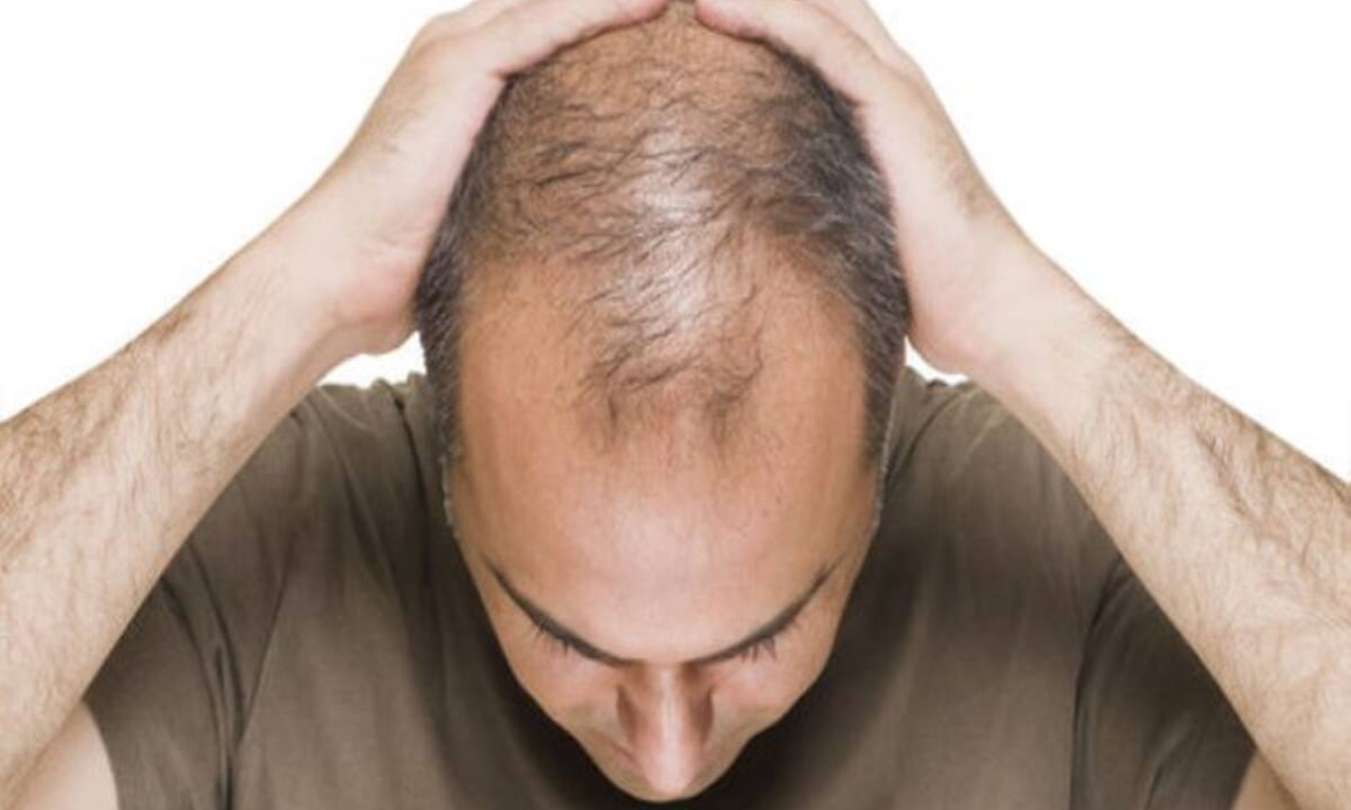 ஓ...! இதுதான் வழுக்கை விழுவதற்கு காரணமா?