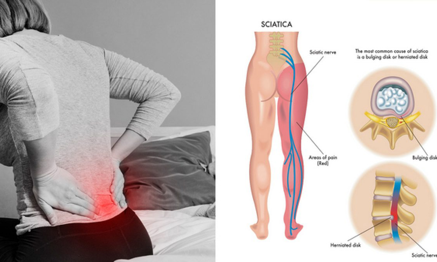 `சயாட்டிகா' பிரச்சினைக்கான சித்தமருத்துவ தீர்வு