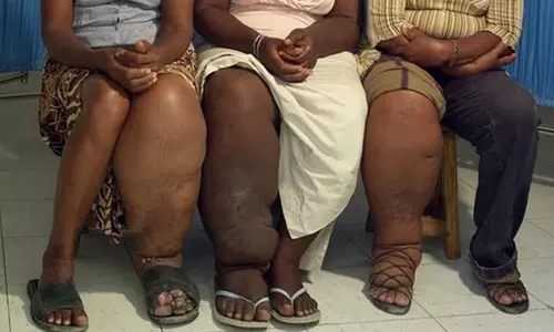 யானைக்கால் நோய்க்கான மருத்துவ தீர்வுகள்