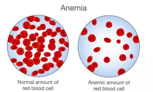முதுமையில் ரத்தசோகை நோயும், தீர்வுகளும்