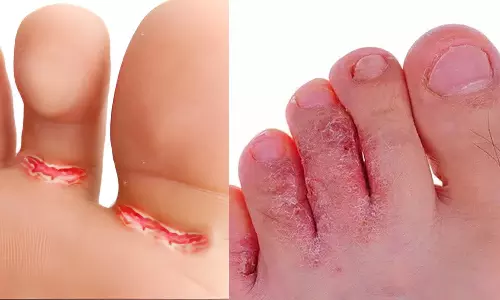 சேற்றுப்புண் பிரச்சினைக்கு சரியான தீர்வு