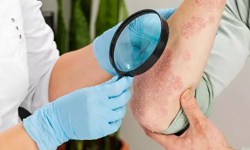 முதுமையில் சோரியாசிஸ் நோயும், தீர்வுகளும்...