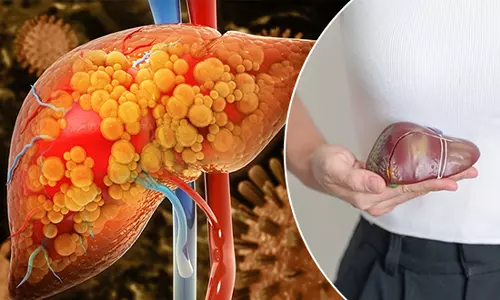 கல்லீரலுக்கு ஆப்பு வைக்கும் உணவு பழக்கவழக்கம்