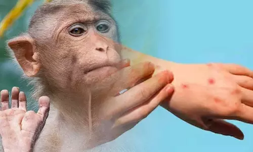 குரங்கு அம்மை நோயால் 21 பேர் பாதிப்பு