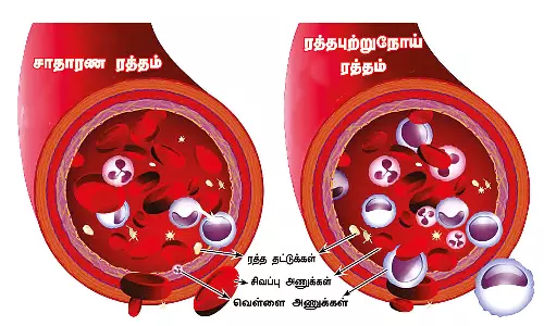 மரபணு மாற்றங்களால் ரத்தபுற்றுநோய் ஏற்படும்...!