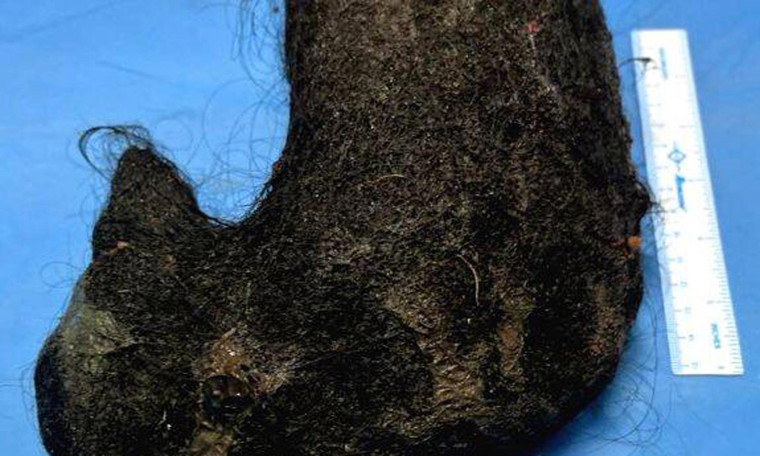 சிறுமியின் வயிற்றில் கட்டியாக சேர்ந்த 2 கிலோ முடி அரசு மருத்துவர்கள்