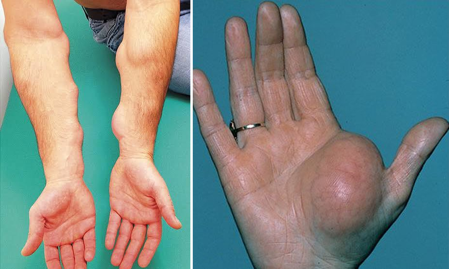 உடலில் உள்ள கொழுப்பு கட்டிகளுக்கு என்ன சிகிச்சை எடுக்கலாம்...?