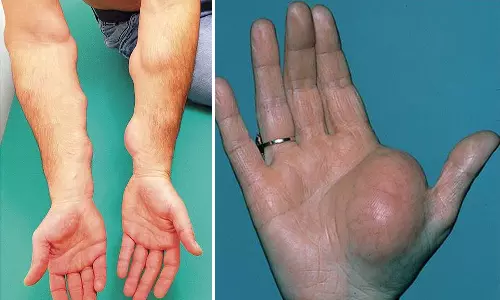 உடலில் உள்ள கொழுப்பு கட்டிகளுக்கு என்ன சிகிச்சை எடுக்கலாம்...?