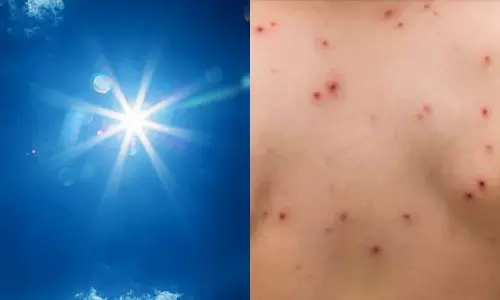 தமிழகத்தில் அம்மை நோய் பரவும் அபாயம்