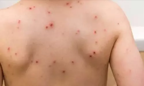 அம்மை பாதிப்பு அதிகரிப்பு: தடுப்பூசி போட்டுக்கொள்ள டாக்டர்கள் அறிவுறுத்தல்