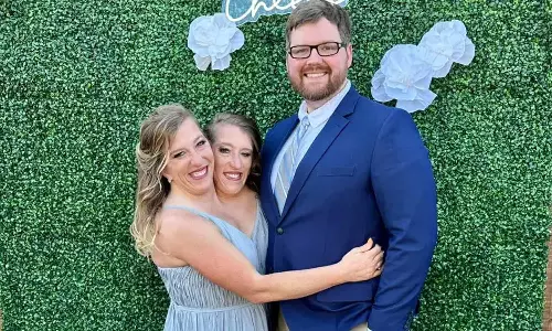 தலை ஒட்டிப் பிறந்த பெண்ணை திருமணம் செய்த ராணுவ வீரர்