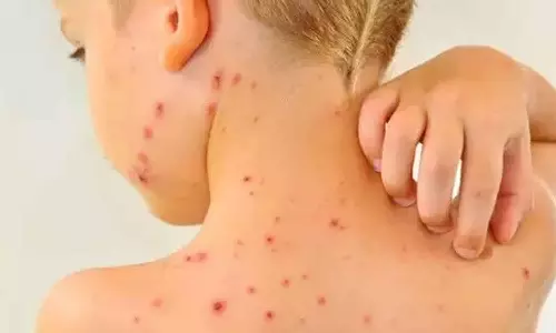 சின்னம்மை நோய் பரவாமல் தடுப்பது எப்படி?