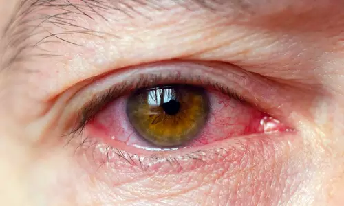 கோடை வெயில் கொளுத்துவதால் சென்னையில் கண் நோய் பாதிப்பு அதிகரிப்பு