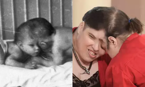 உலகின் மிக வயதான ஒட்டிபிறந்த இரட்டை சகோதரிகள் மரணம்