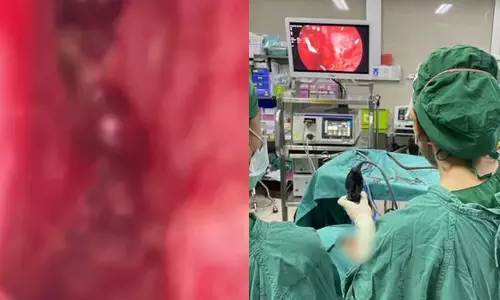 பரிசோதனையில் அதிர்ச்சி- பெண்ணின் மூக்கில் இருந்து 100க்கும் மேற்பட்ட புழுக்களை அகற்றிய மருத்துவர்கள்