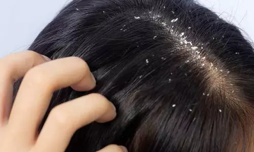 பொடுகுத்தொல்லையில் இருந்து விடுபட சிறந்த வழி