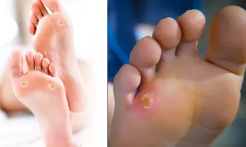 கால் ஆணி எதனால் வருகிறது? அதற்கான தீர்வு தான் என்ன?