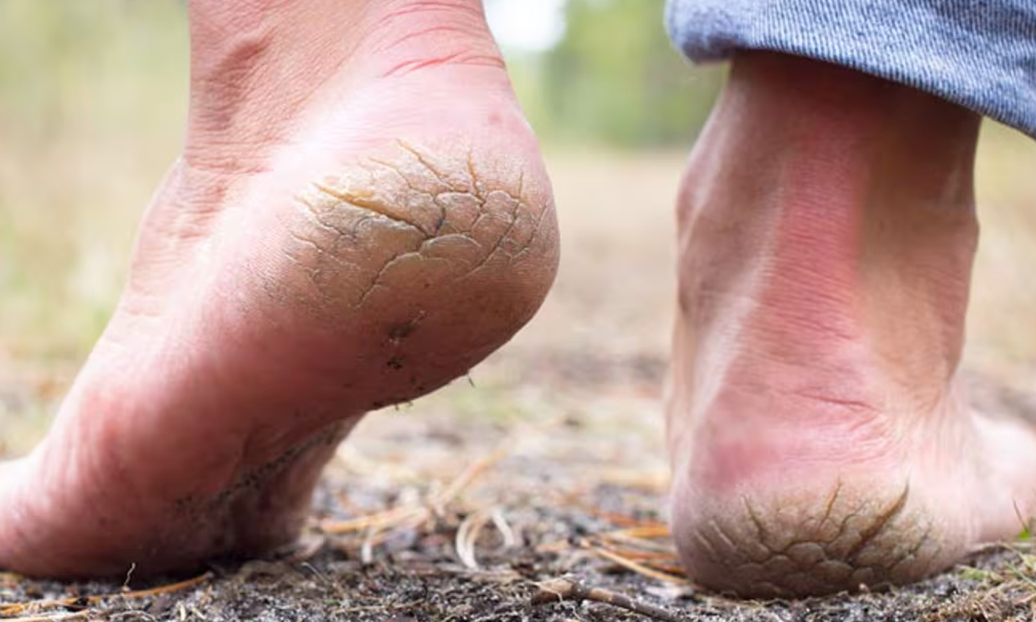 குதிகால் வெடிப்பு நீங்க எளிய வழிகள் | Easy Ways to Get Rid of Cracked Heels