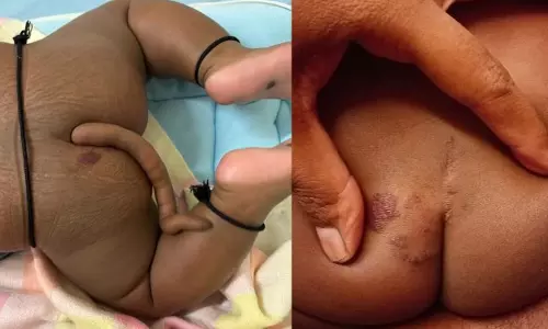 ஐதராபாத்தில் வாலுடன் பிறந்த அதிசய குழந்தை