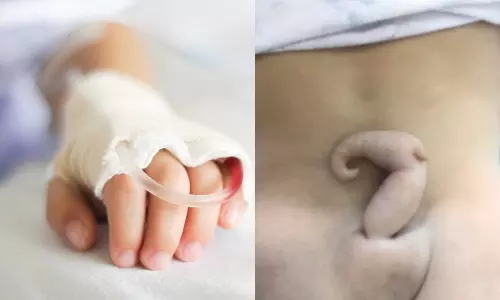 3 மாத குழந்தையின் முதுகில் 15 செ.மீ. நீள வாலை அகற்றி மருத்துவர்கள் சாதனை