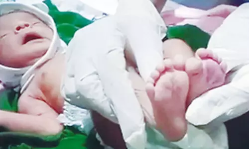 25 விரல்களுடன் பிறந்த அதிசய ஆண் குழந்தை