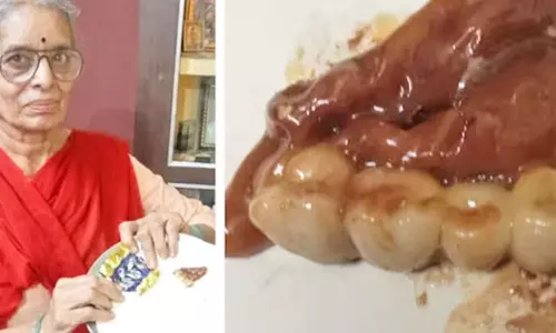 பிறந்தநாள் சாக்லேட்டில்  இருந்த செயற்கை பற்கள்