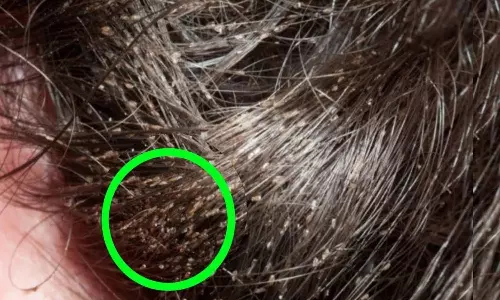 பேன் தொல்லையா இதை ட்ரை பண்ணி பாருங்க!