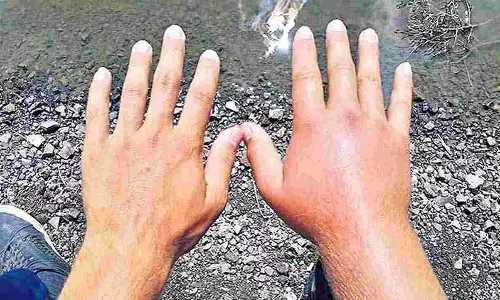 ஆந்திராவில் கை, கால் வீக்கத்துடன் புதுவகை காய்ச்சல் உஷார்....