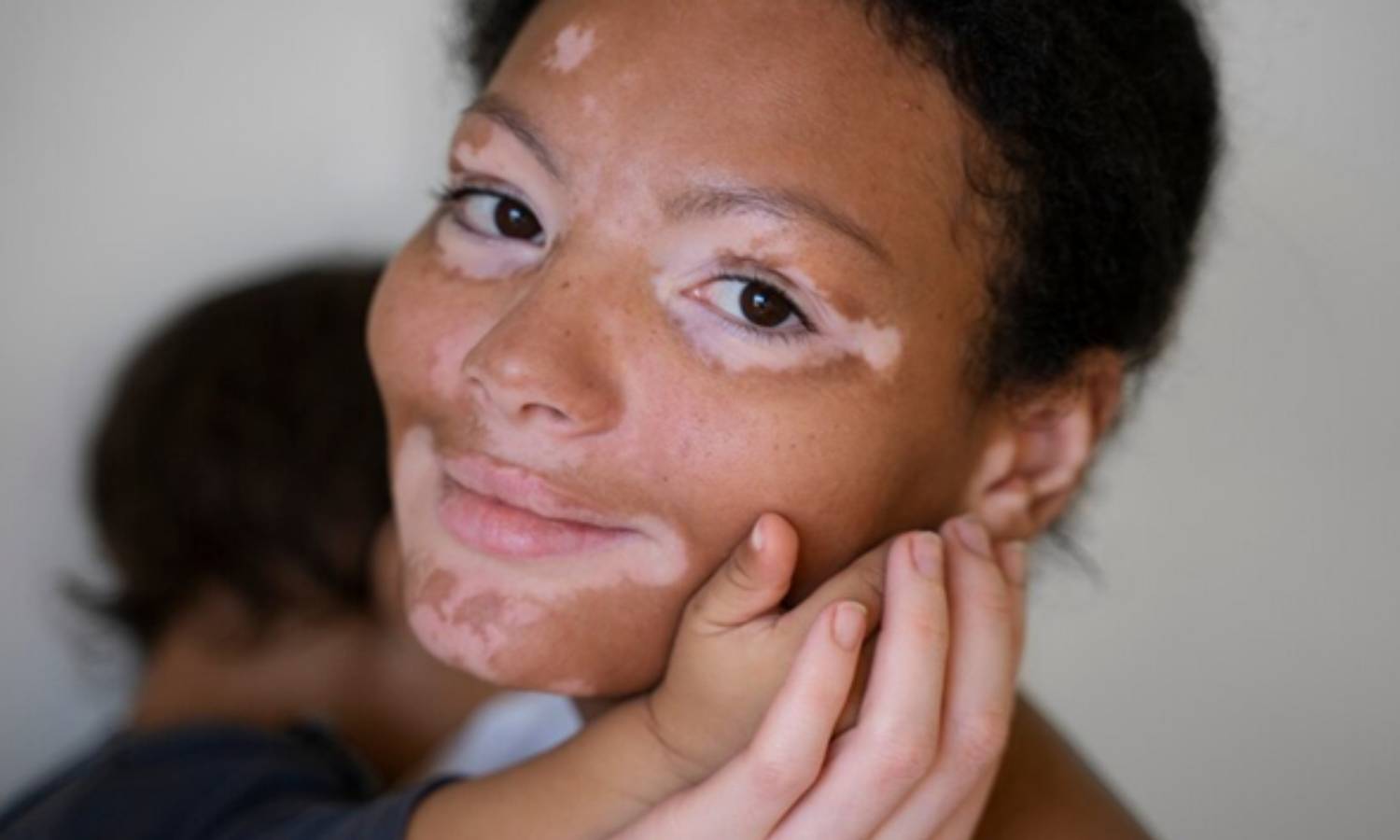 வெண்புள்ளிகள் ஏன் ஏற்படுகிறது? தடுக்கும் வழிகள்! வெண்புள்ளிகள் ஏன் ஏற்படுகிறது? தடுக்கும் வழிகள்!