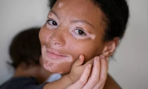 வெண்புள்ளிகள் ஏன் ஏற்படுகிறது? தடுக்கும் வழிகள்!