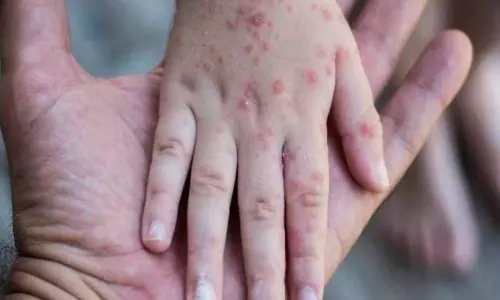 குரங்கம்மை: அச்சுறுத்தல்களும்.. அபாயங்களும்..!