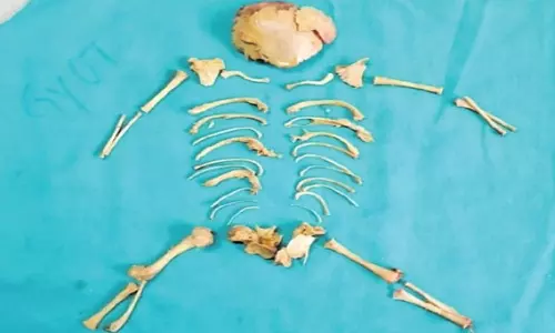 கருக்கலைப்பு மாத்திரையால் விபரீதம்: பெண்ணின் வயிற்றில் இருந்த எலும்புக் கூடு