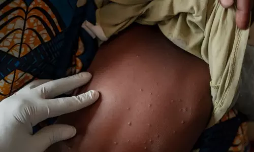 குரங்கம்மை நோய்க்கு தடுப்பூசி - உலக சுகாதார மையம் அனுமதி