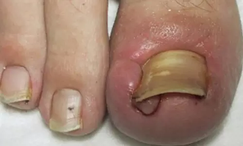 உள்நோக்கி வளரும் கால் நகங்கள்....காரணம் என்ன தெரியுமா?