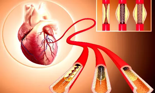 ஆஞ்சியோபிளாஸ்டி என்றால் என்ன? அதன் சிகிச்சை முறைகள்