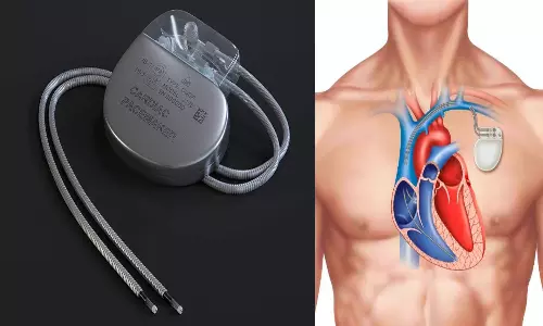 இதய நோயாளிகளுக்கு செய்யப்படும் பேஸ் மேக்கர் சிகிச்சை