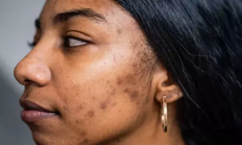 முக அழகை கெடுக்கும் கரும்புள்ளிகள், தழும்புகள் மறைய சில டிப்ஸ்